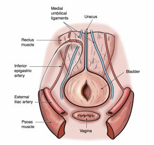 peritoneal incision