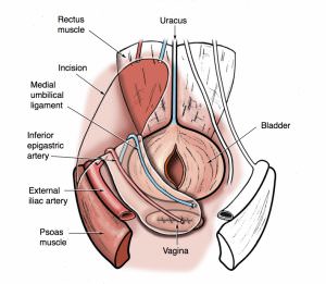 image of peritoneal flap rotation